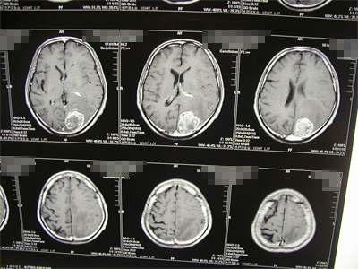 転移性脳腫瘍の写真
